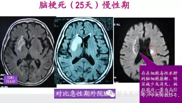 脑梗塞分期的最新标准,脑梗塞分期的最新标准